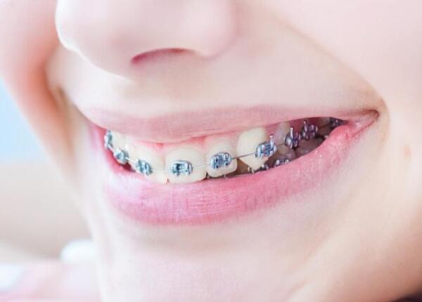 戴了牙套可以用電動(dòng)牙刷嗎？戴牙套的人群必看！